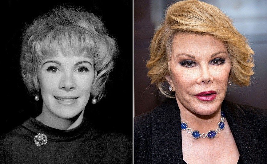 Joan Rivers 3 - most expensive celebrity plastic surgeries
